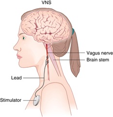 Vagus nerve shop and tinnitus