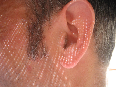 Tinnitus in One Ear Only?