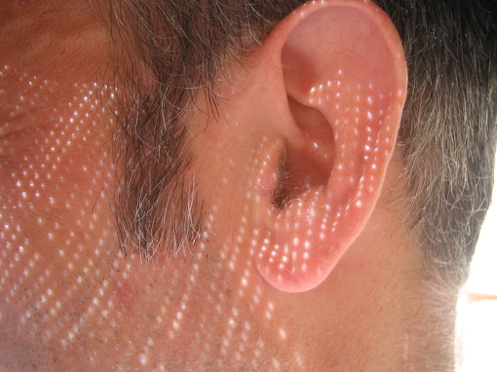 Tinnitus in deals one ear only